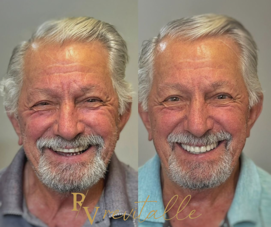 Antes e depois Valmor